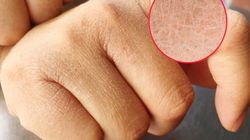 Skóra banknotowa jest sygnałem alarmowym. To znak, że wątroba szwankuje