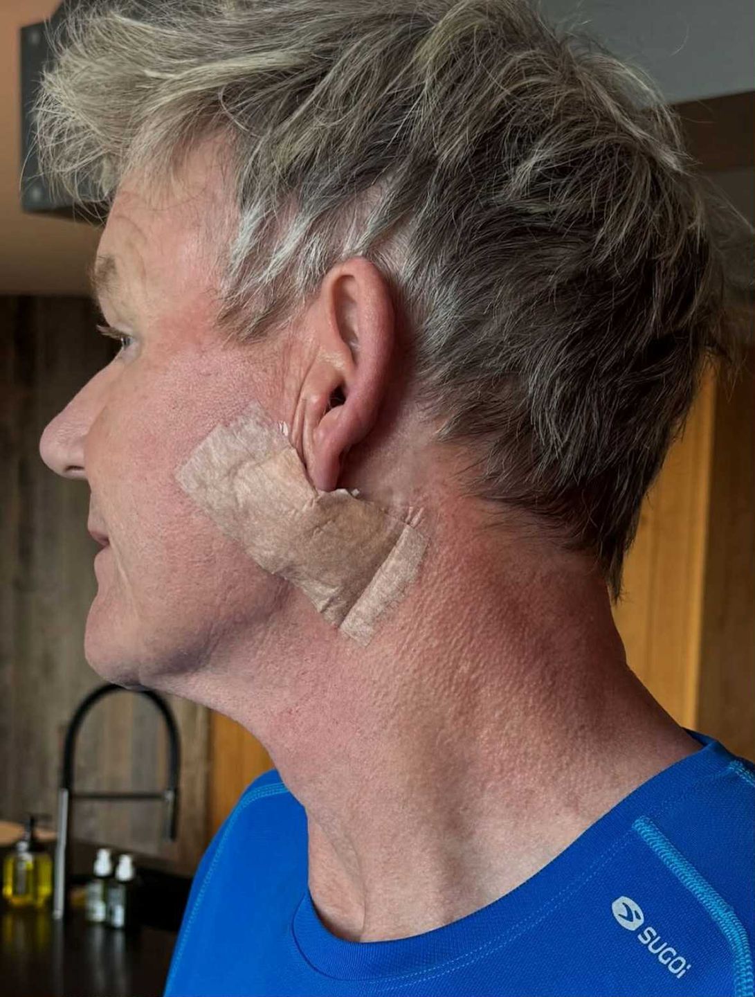 Gordon Ramsay walczy z rakiem skóry