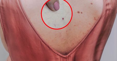Na twoim ciele pojawiły się "rubinki"? To może być sygnał alarmowy