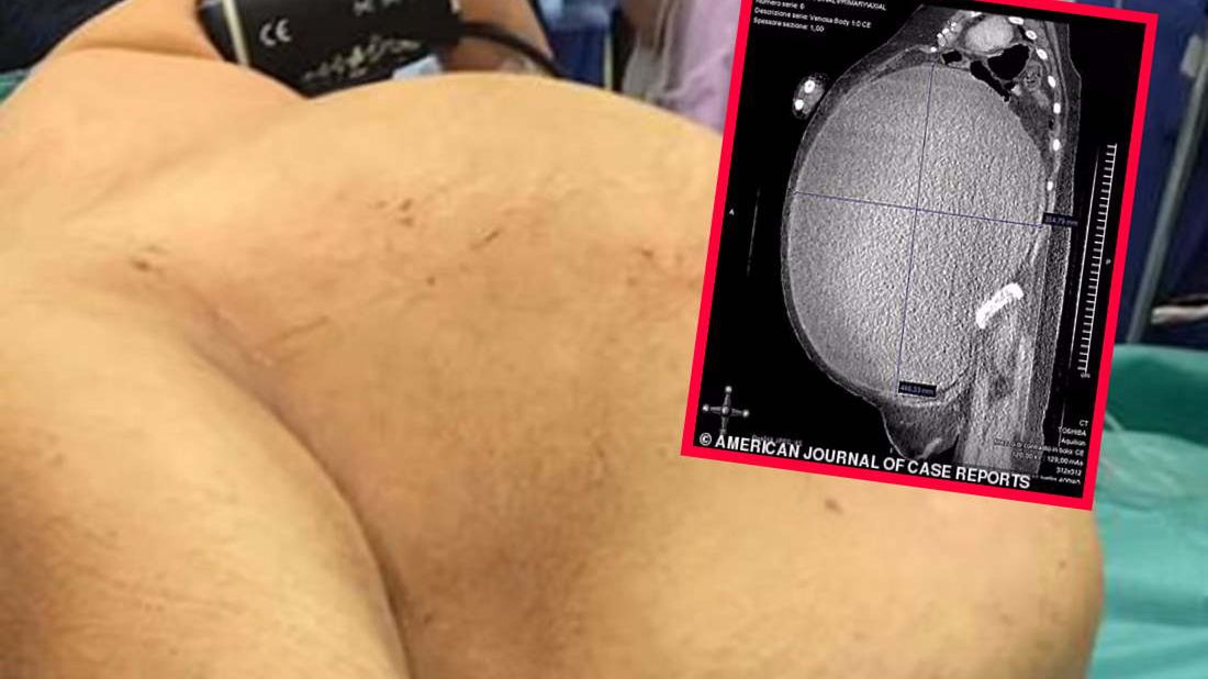 Do szpitala trafiła 52-letnia kobieta z gigantyczną torbielą. Miała wielkość piłki lekarskiej