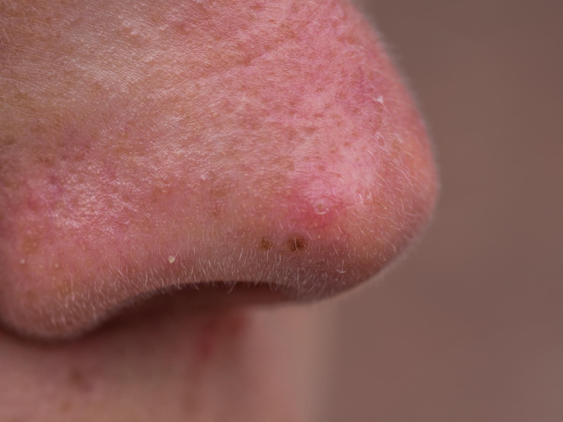 Nadmiar alkoholu może powodować problemy skórne