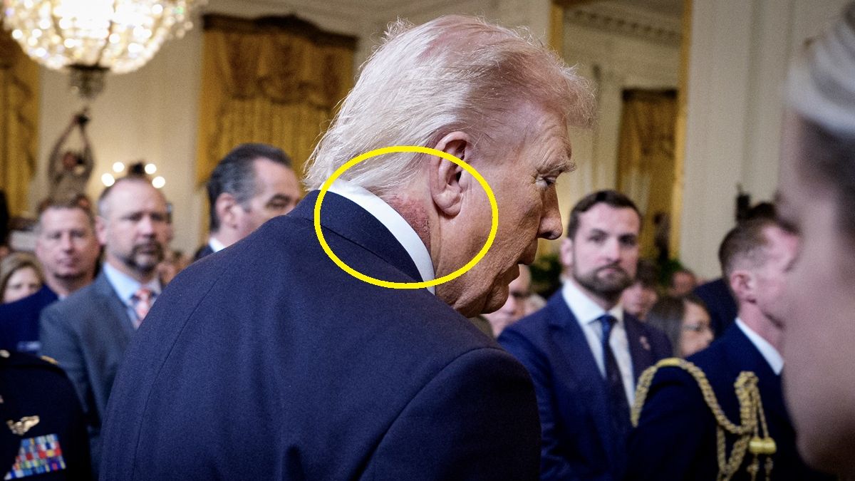 Wysypka na szyi Donalda Trumpa.