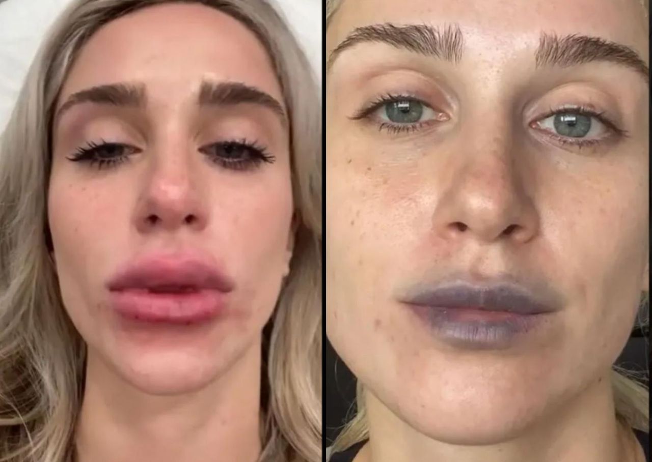 Chciała upiększyć usta. "Po wypełnieniu są spuchnięte, niebieskie i grudkowate"