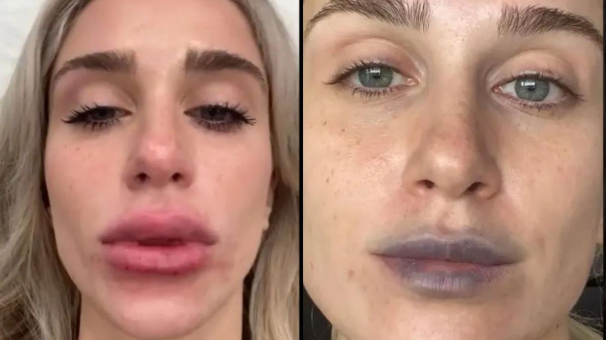 Chciała upiększyć usta. "Po wypełnieniu są spuchnięte, niebieskie i grudkowate"