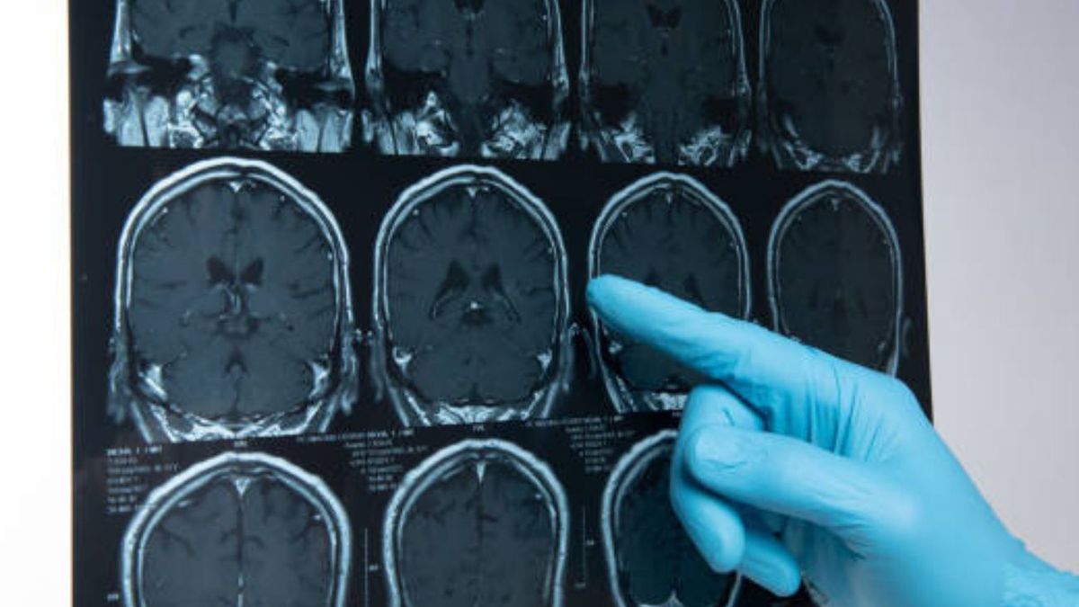 Udar mózgu: szybka reakcja kluczem do zdrowia