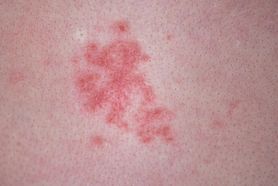 Czerwone plamy na ciele – przyczyny i leczenie