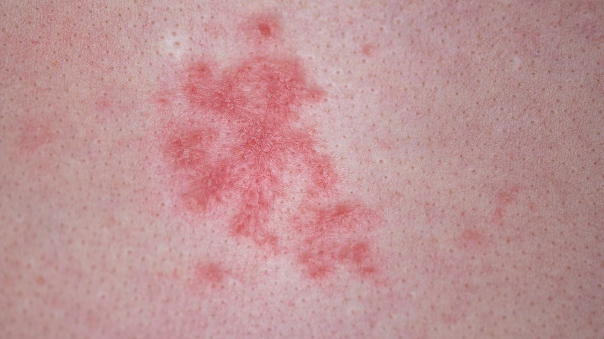 Czerwone plamy na ciele mogą pojawić się po zażyciu leków