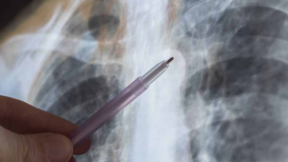 X-ray scan of Human bones disease. Spine cancer. Doctor learn diagnosis.
VADYM 
anatomy, back, backbone, body, bone, cancer, carcinoma, care, clinical, ct, diagnosis, disease, doctor, education, examination, hospital, human, illness, inflammation, injury, learning, medical, medicine, metastasis, mri, orthopedic, osteoarthritis, osteoporosis, pain, radiography, radiology, scan, skeletal, skeleton, spinal, spine, surgery, trauma, treatment, tumor, vertebra, vertebral, x-ray, mri, examination, learning, doctor, spine, bone, cancer, skeletal, metastasis, ct, carcinoma, x-ray, treatment, vertebral, tumor, education, osteoarthritis, vertebra, clinical, hospital, radiography, osteoporosis, surgery, disease, pain, human, backbone, anatomy, diagnosis, injury, skeleton, radiology, medical, medicine, illness, care, trauma, body, spinal, inflammation, back, scan, orthopedic