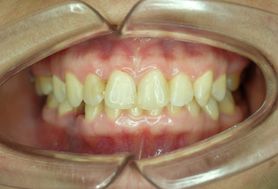 Zgryz głęboki – leczenie, rysy twarzy i przyczyny wady