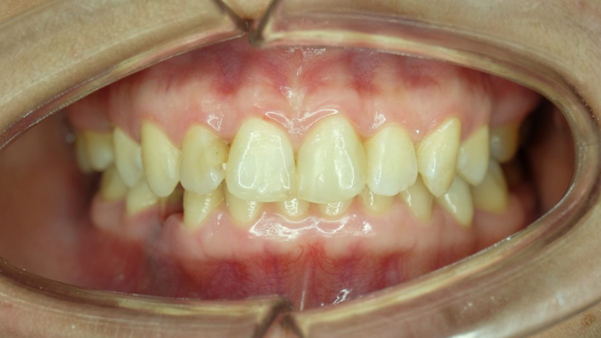 Zgryz głęboki – leczenie, rysy twarzy i przyczyny wady