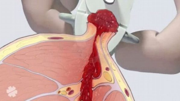 Zamiast opaski uciskowej spinacz. Rewolucja w tamowaniu krwawienia [wideo] 1