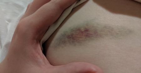 Siniaki powstają bez powodu? Mogą świadczyć o poważnej chorobie