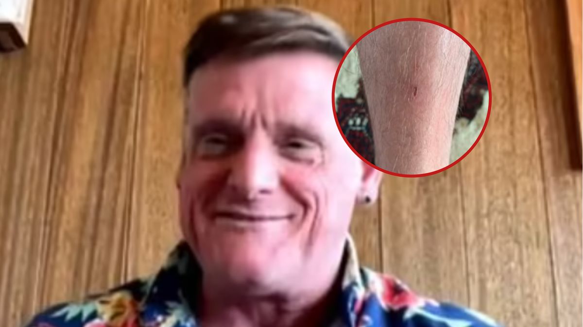 U mężczyzny zdiagnozowano COVID-19 i małpią ospę w tym samym czasie