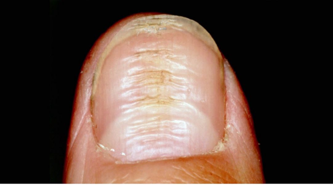 Cukrzyca może objawiać się na paznokciach. Nie lekceważ takich zmian