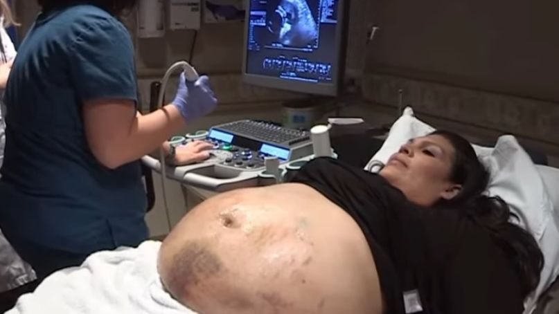 Jej brzuch pokrywały siniaki. Okazało się, że to przez to, że nosi pieciąraczki