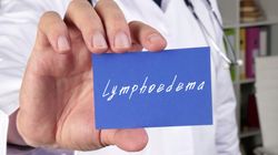 Obrzęk limfatyczny - przyczyny, objawy i leczenie