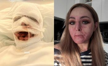 Tiktokerka, która płonęła żywcem na imprezie, pokazała, jak dziś wygląda: "Ciężkie jest pogodzenie się ze swoją nową wersją" (ZDJĘCIA)