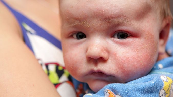 trądzik niemowlęcy