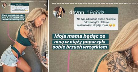 Deynn ma bliznę. Tłumaczy to wypadkiem mamy w ciąży