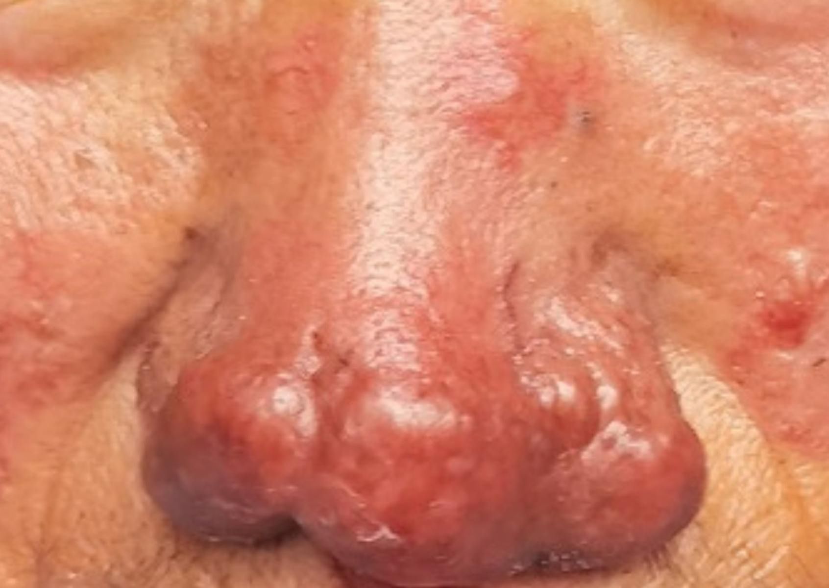 Toczeń odmrozinowy, czyli lupus pernio w sarkaidozie skórnej