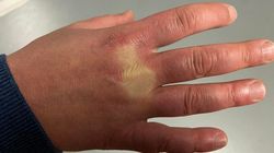 Objaw pojawia się na dłoniach. Pierwszy zwiastun choroby serca i nerek