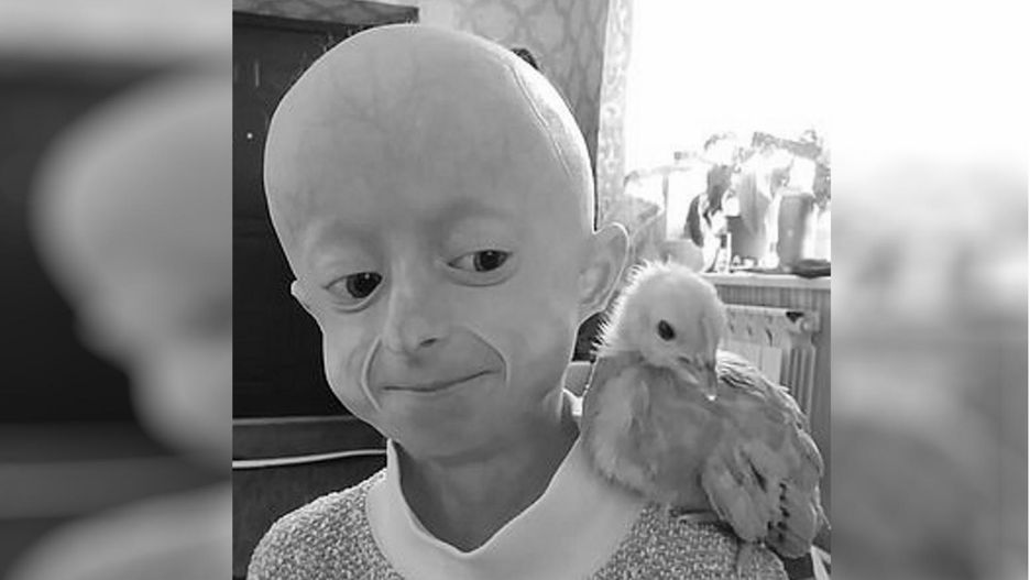 10-latka w ciele 80-latki. Zmarła Irina Chimich