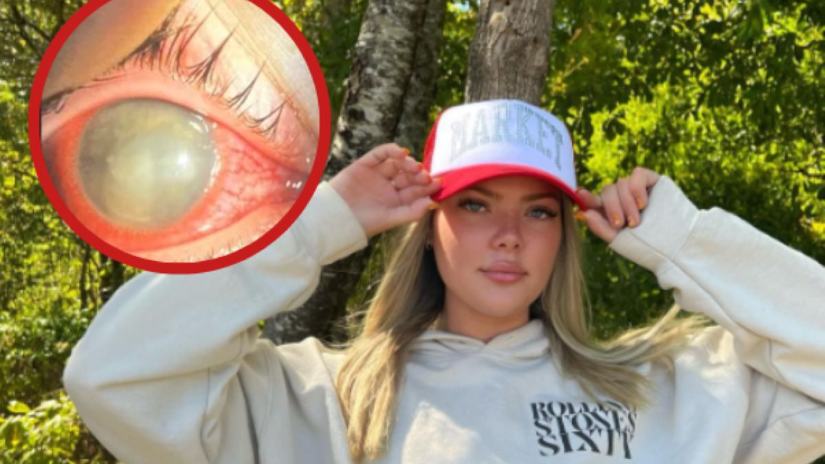 Brooklyn Mccasland straciła wzrok w prawym oku