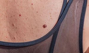 Masz "rubinki" na skórze? Od razu idź do lekarza