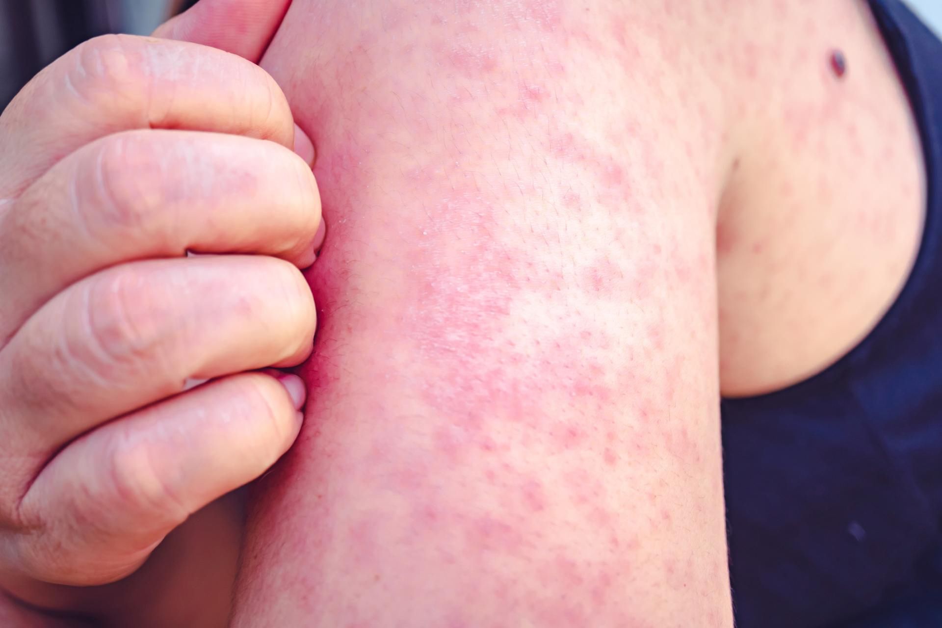 Będzie epidemia? Wróciła groźna choroba zakaźna