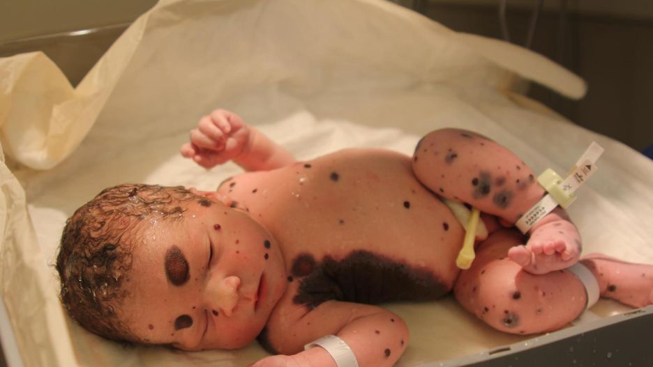 Jego ciało było w 80 proc. pokryte znamionami. Tak wygląda po latach