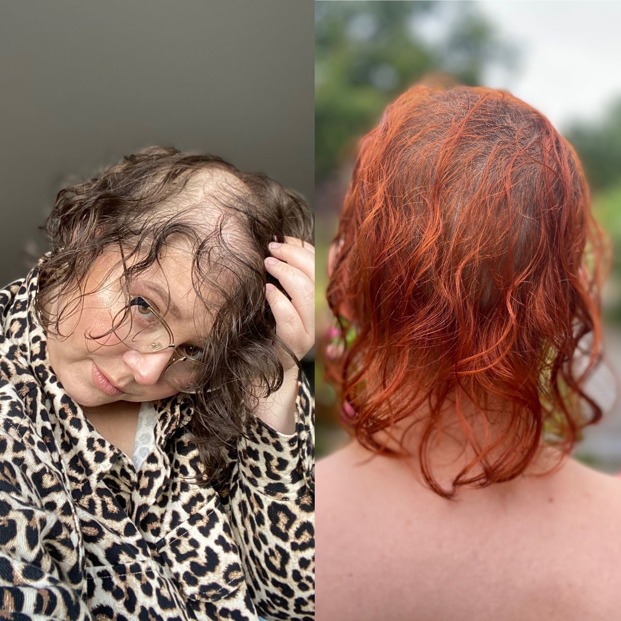 Ewa Mazurek walczy z pocovidowym wypadaniem włosów