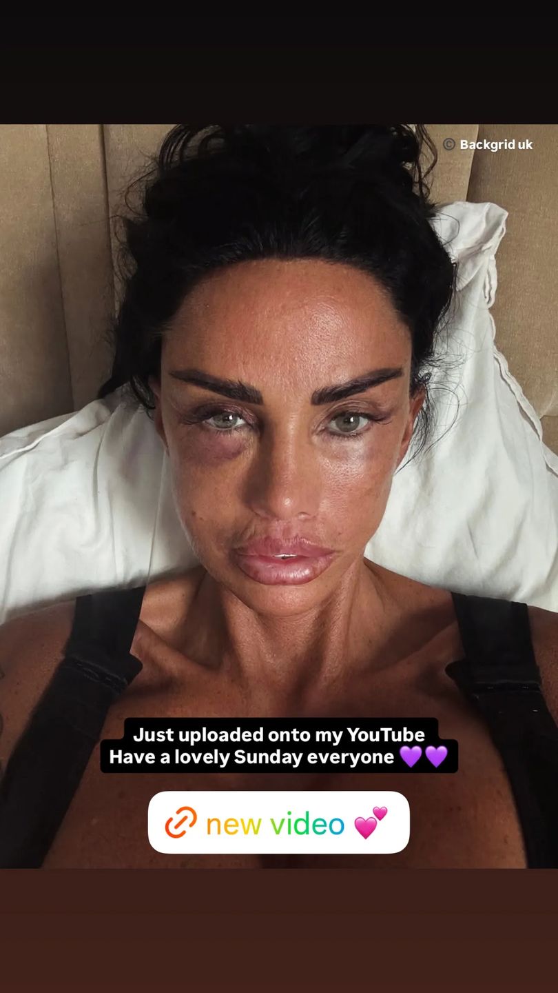 Posiniaczona i opuchnięta Katie Price