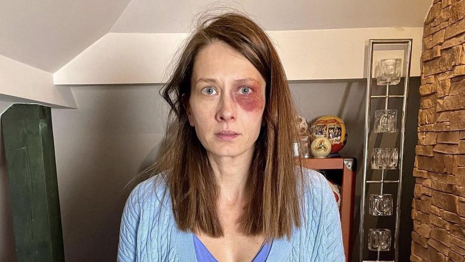 Ania Sokołowska zszokwoała fanów zdjęciem z podbitym okiem