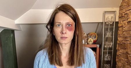 Anita Sokołowska z podbitym okiem. Fani zaniepokojeni: "Kto tak panią urządził?!"