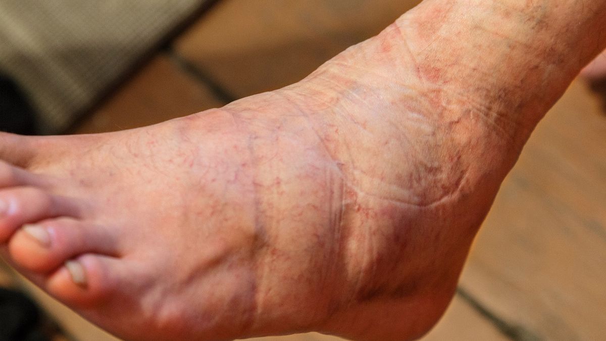 Ból i zmiana koloru nóg może oznaczać problemy z tętnicami