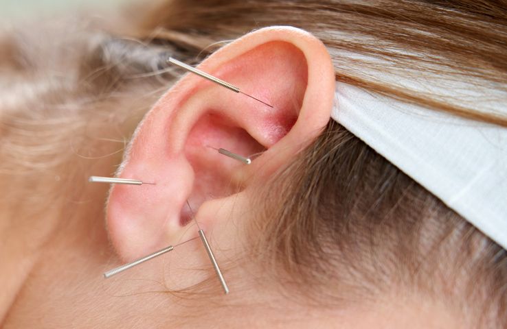 Akupunktura ucha pomaga zrzucić zbędne kilogramy