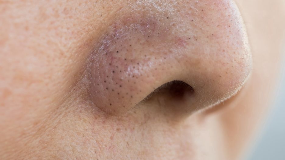 Ta maseczka domowej roboty pozwala szybko pozbyć się zaskórników