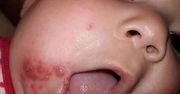 Zauważyła dziwne bąble na twarzy niemowlęcia. Okazało się, że to opryszczka