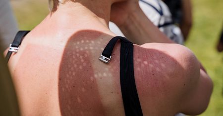 Poparzona skóra? Oto co od razu przyniesie ulgę
