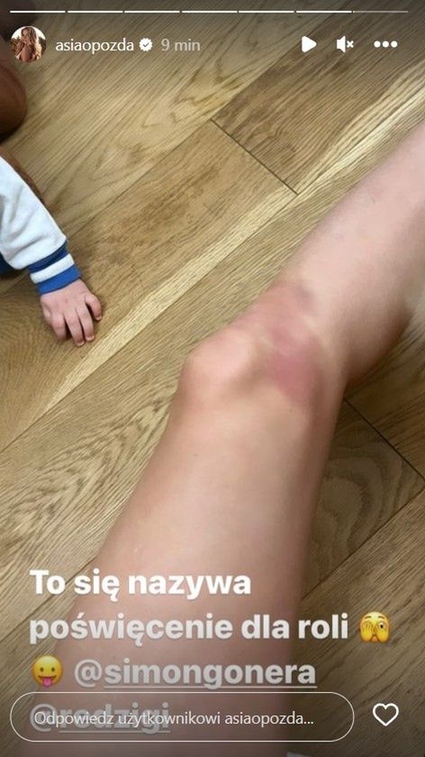 Joanna Opozda  pokazała posiniaczone nogi