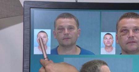 Udana rekonstrukcja twarzy przy użyciu kości wydrukowanych w 3D