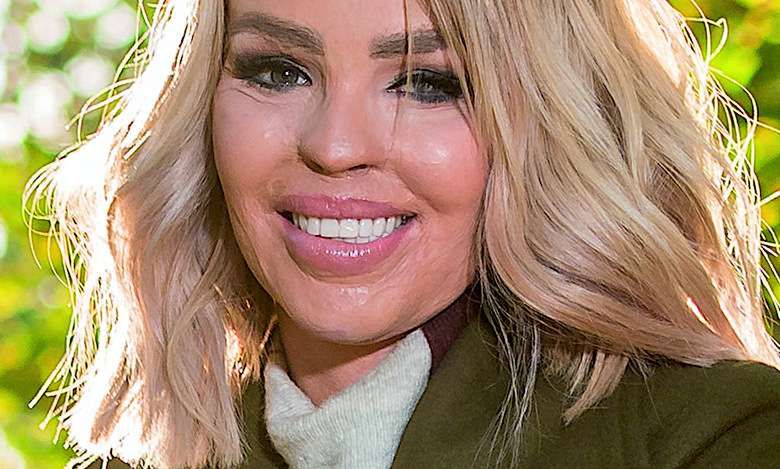 Modelka oblana kwasem pokazała się bez makijażu. Odważne zdjęcie Katie Piper