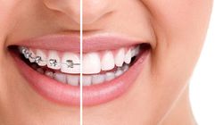 Cena aparatu na zęby - koszt aparatu klasycznego, lingwalnego, samoligaturujacego oraz leczenia