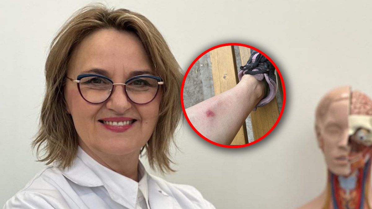 Na nodze pojawiła się swędząca gruda. "Jestem weteranką boreliozy"