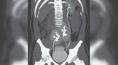 Miał trzy nerki. Lekarze w szpitalu nie mogli w to uwierzyć