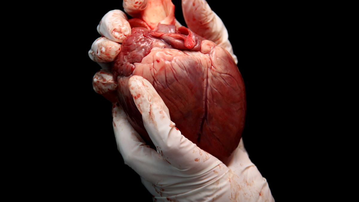 Przeszczep serca to inaczej zabieg transplantacji serca.