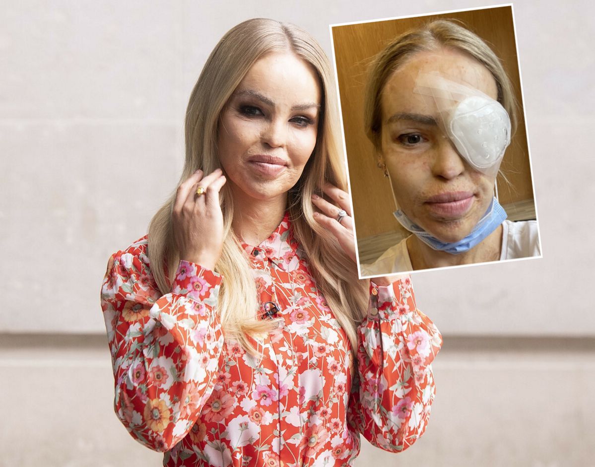 Katie Piper jest już po kolejnej operacji