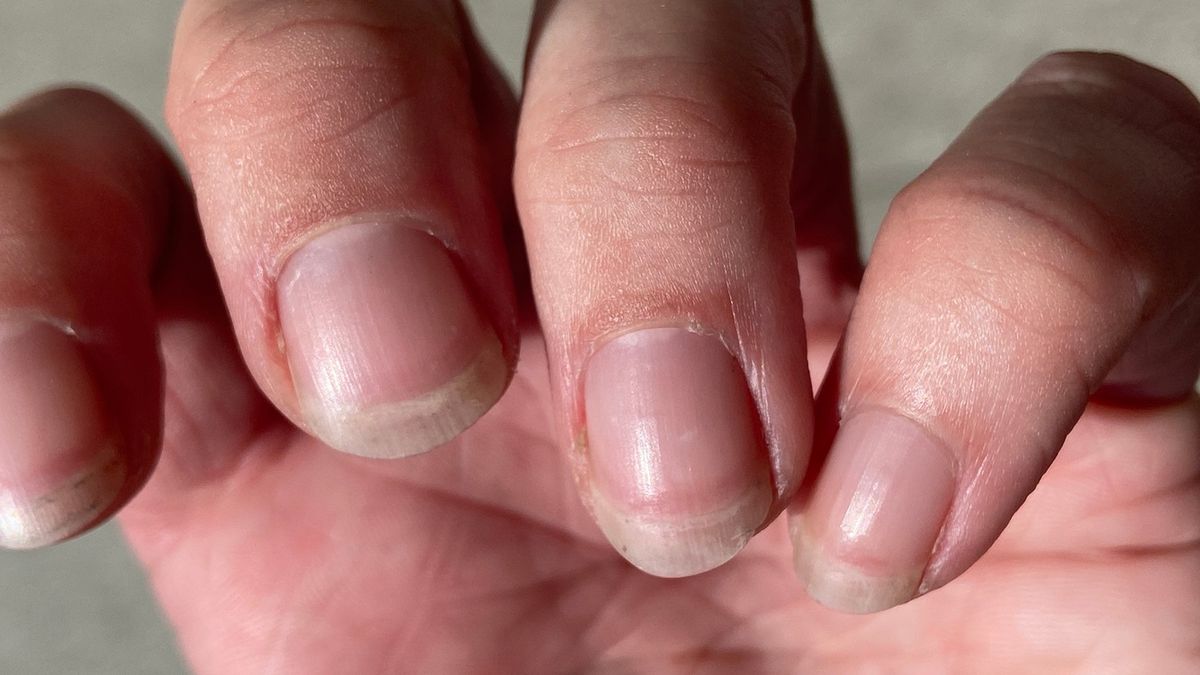 Zmiany na płytce paznokcia mogą być jednym z pierwszych objawów marskości wątroby