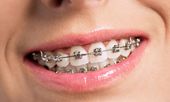 Na aparat ortodontyczny nigdy nie jest za późno