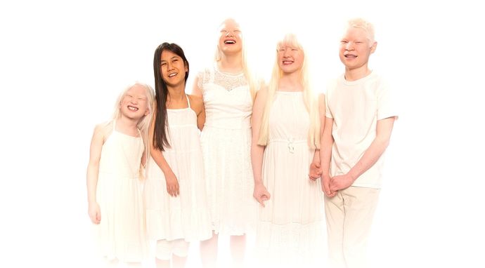 Urodzeni z albinizmem